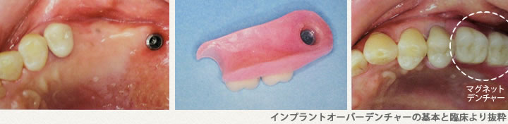 ノンクラスプデンチャーとマグネットデンチャーを組み合わせたコンパクトな義歯の１例