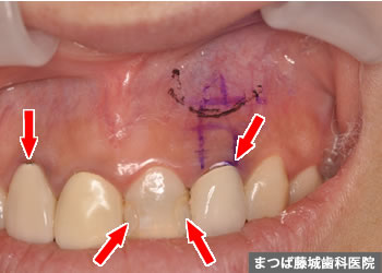 歯根嚢胞　治療写真1