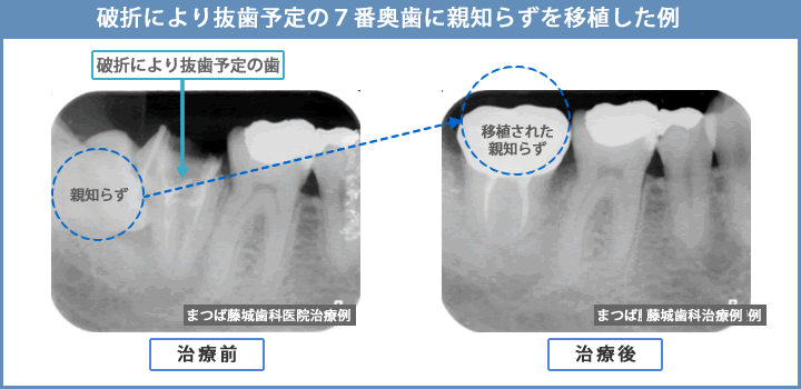 破折により抜歯予定の７番奥歯に親知らずを移植した例