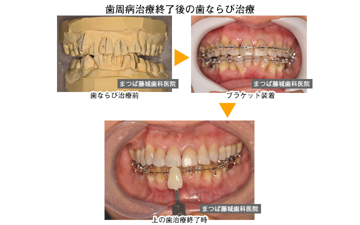 歯周病治療終了後の歯ならび治療