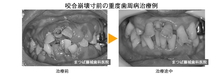 歯周病治療終了後の歯並び治療