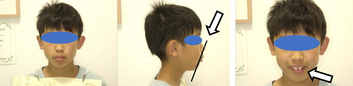 成長期を生かした矯正治療例の写真１