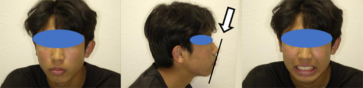 成長期を生かした矯正治療例の写真２
