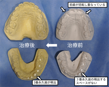 成長期を生かした矯正治療例の写真３