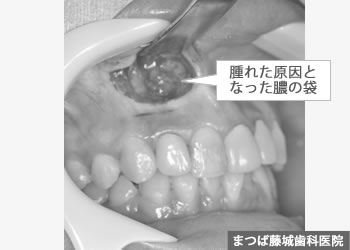 歯根嚢胞　治療写真2