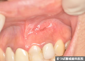 歯根嚢胞　治療写真4