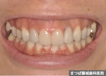 歯根嚢胞　治療写真5
