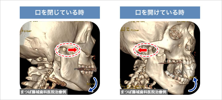 顎関節症